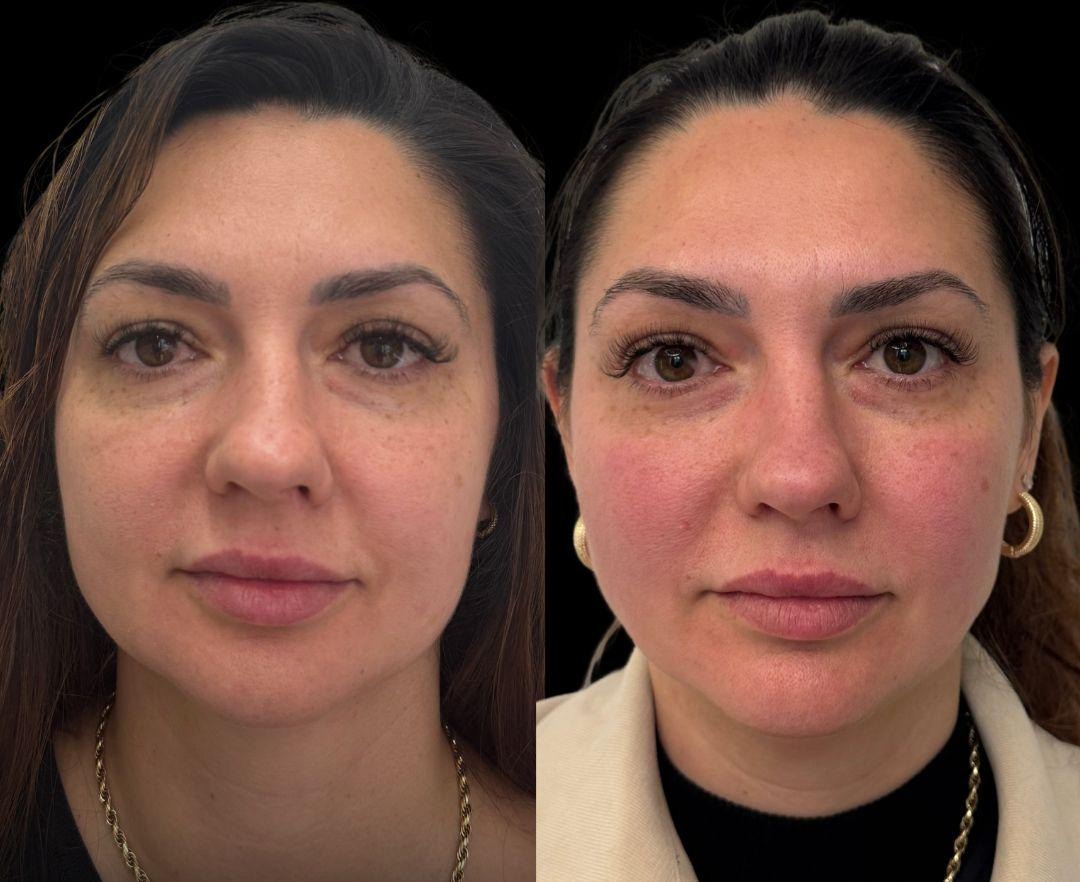 Antes e depois de um caso real de equilíbrio facial