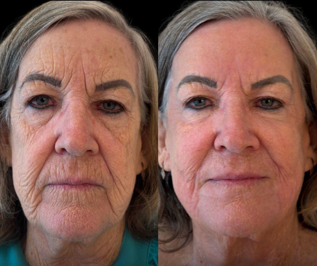 Antes e depois de uma paciente em caso real