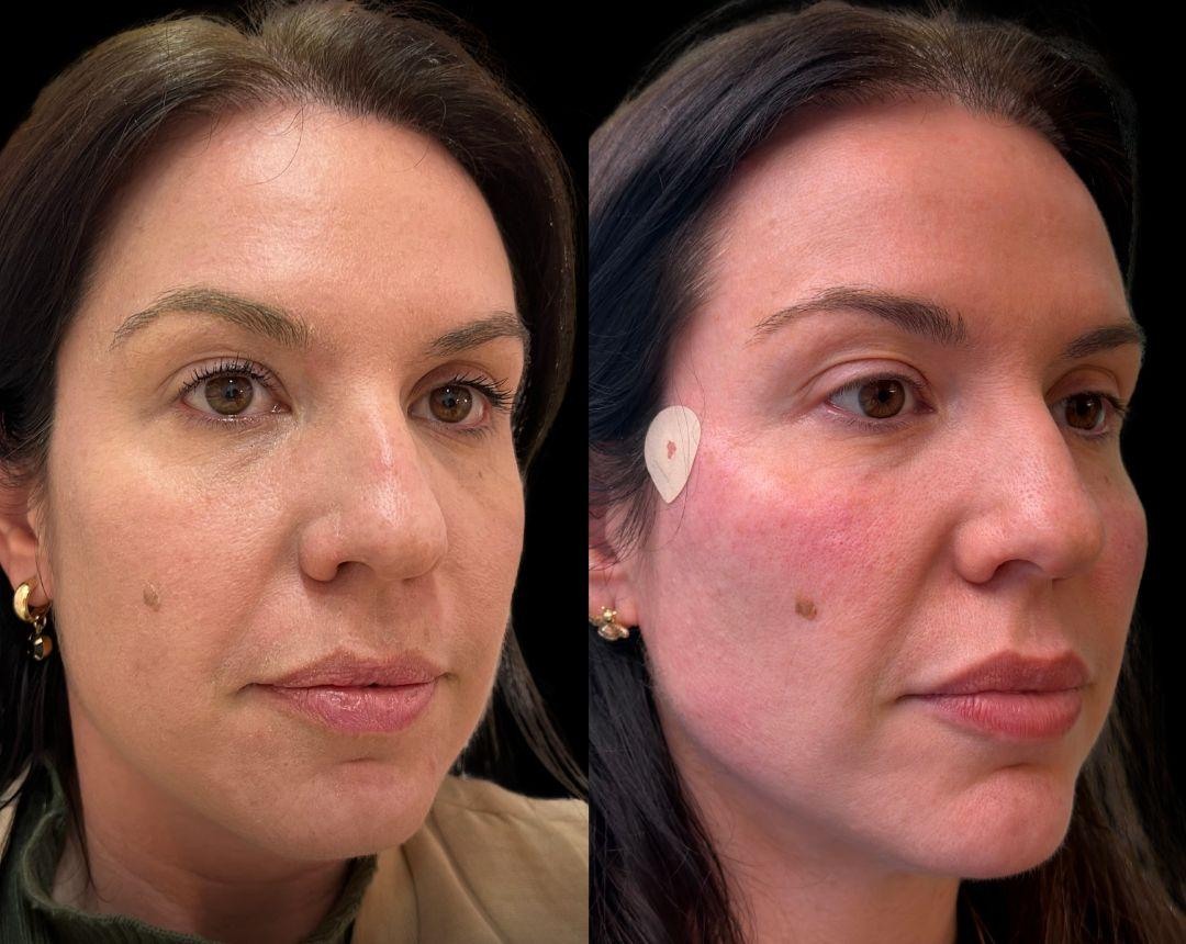 Comparação antes e depois de um caso real de perfil